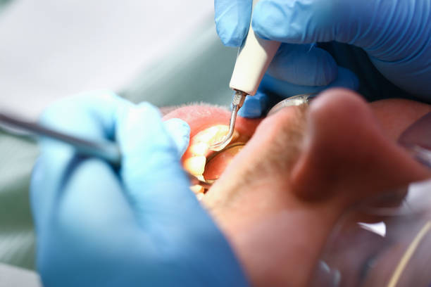 Best Emergency Dentist for Knocked-Out Tooth in West Haven, UT